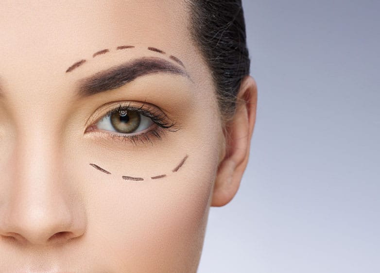 Revision Eyelid Surgery St. Louis 