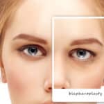 Eyelid Blepharoplasty St. Louis, MO