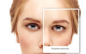 Eyelid Blepharoplasty | Ophthalmic Plastic & Cosmetic Surgery Inc.