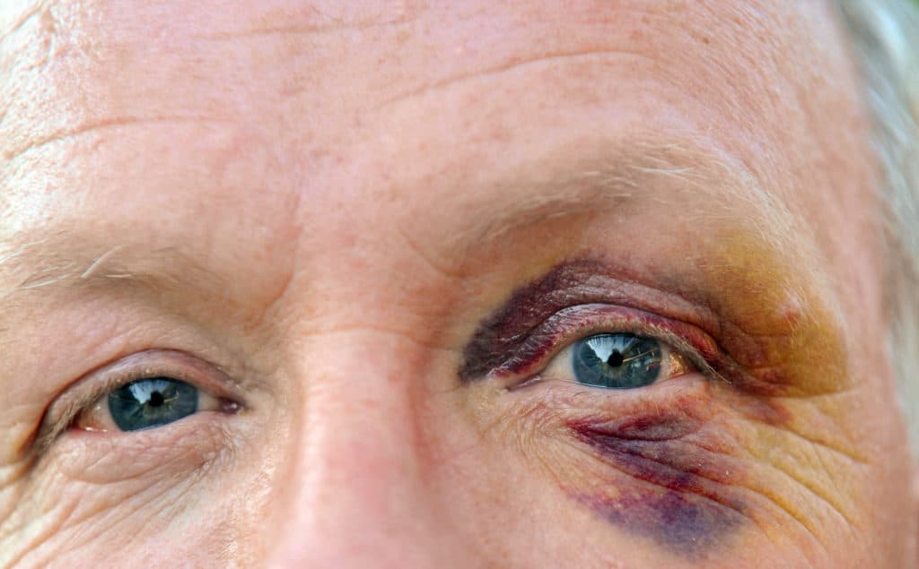 older man with bruise around left eye from orbital trauma
