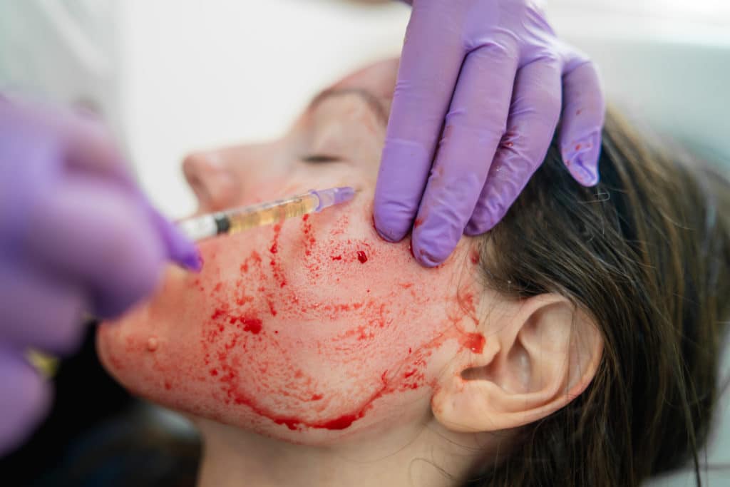 Young woman undergoing microneedling treatment on her cheek