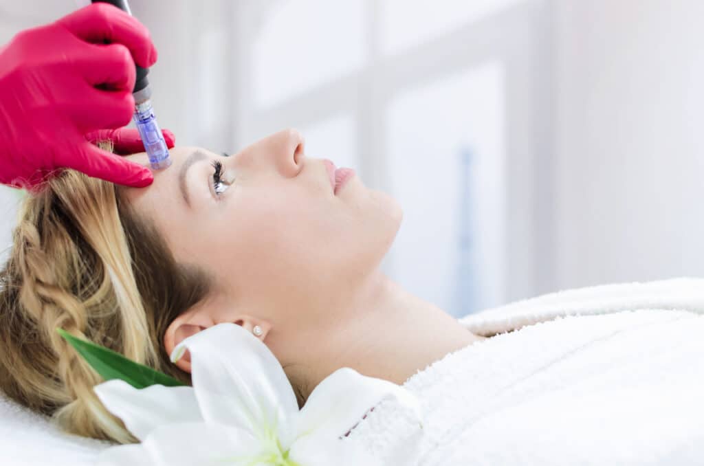 Woman undergoing microneedling treatment on her forehead