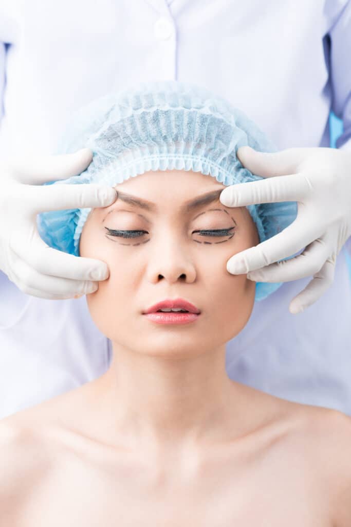 asian woman laying down, eyes closed with dotted lines drawn around them, being prepared by doctor for eyelid surgery