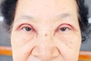 A close up portrait image of an elderly Asian woman that underwent Double Eyelid Surgery