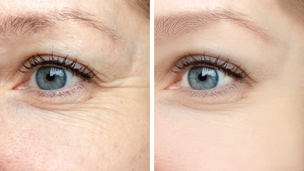 Belotero Before and after wrinkle treatments
