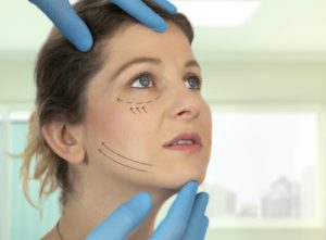 A plastic surgeon drawing in guidelines on a patients face, prepping them for a mid-facelift
