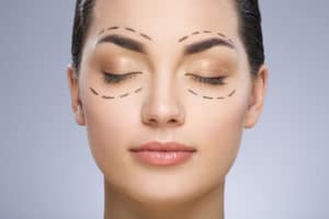 Answers to Common Blepharoplasty Questions