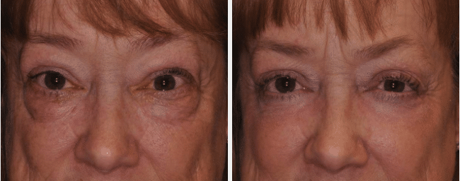 A before and after image set of a woman that underwent a lower blepharoplasty