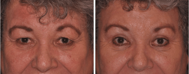 A before and after image set of a woman that underwent a upper blepharoplasty