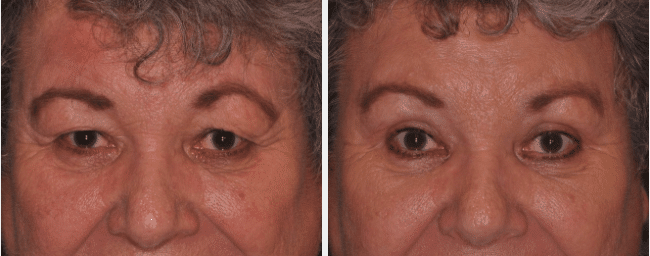 A before and after image set of a woman that underwent a upper blepharoplasty