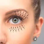 Blepharoplasty Treatment on female eyes