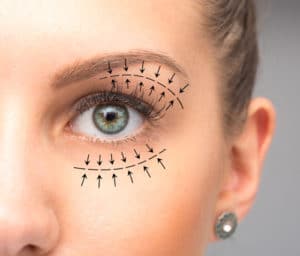 Blepharoplasty Treatment on female eyes