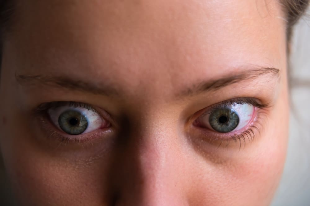 A cropped shot of a woman with thyroid eye disease in St. Louis