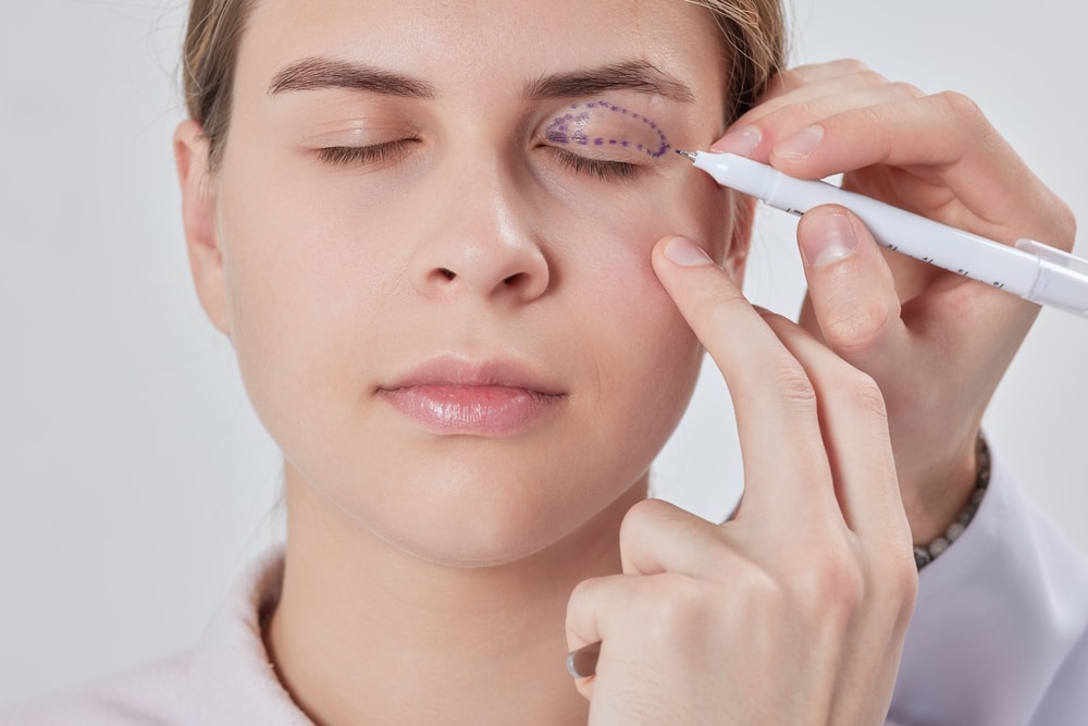 Plastic surgeon preparing for blepharoplasty operation, cosmetic eyelid surgery procedure to improve eye appearance.