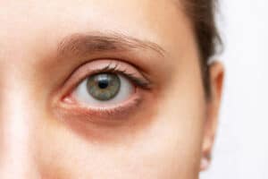 A close-up shot of a woman's eyelid after eyelid cancer reconstruction surgery