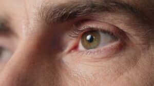 A close-up shot of a man's eyelid after eyelid cancer reconstrution in St. Louis