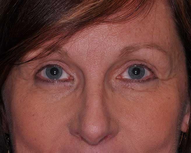 Upper Eyelid Plastic Surgery in St. Louis, MO