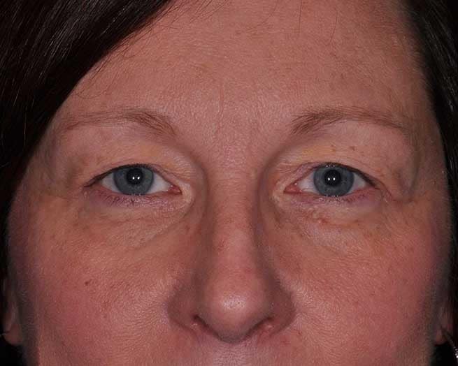 Upper Eyelid Plastic Surgery in St. Louis, MO