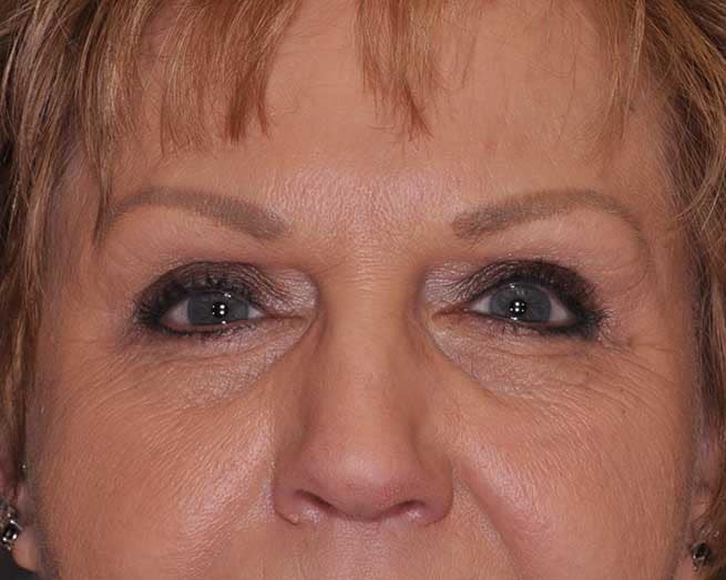 Ptosis Repair St. Louis (Droopy Eyelids)