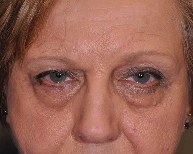 Ptosis Repair St. Louis (Droopy Eyelids)