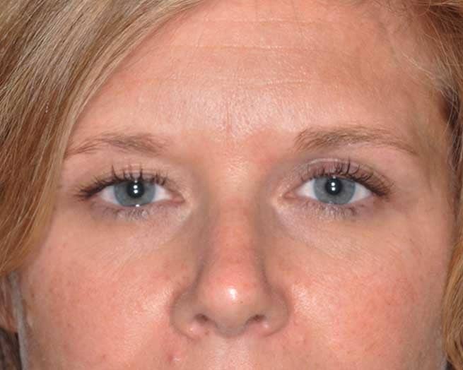 how to avoid eyelid ptosis with botox
