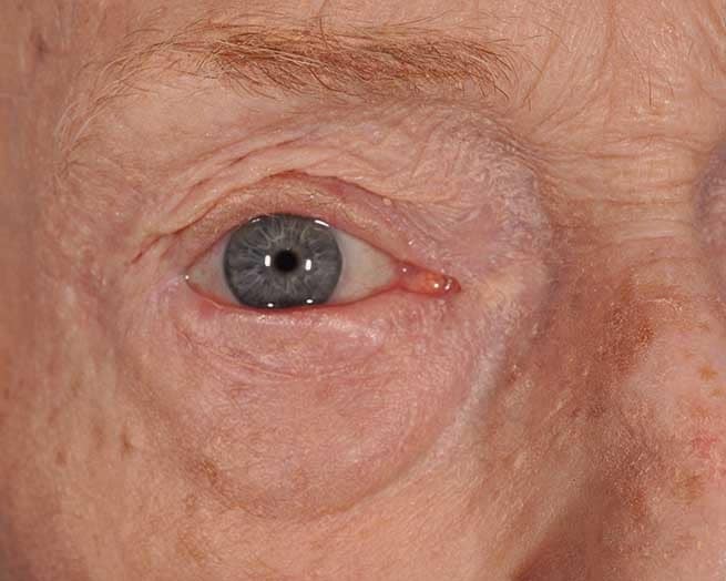 Eyelid Cancer Reconstruction