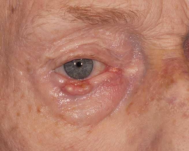 Eyelid Cancer Reconstruction
