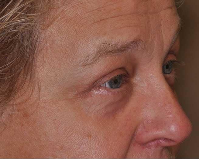 Blepharoplasty (Eyelid Surgery) in St. Louis &#038; St. Peters