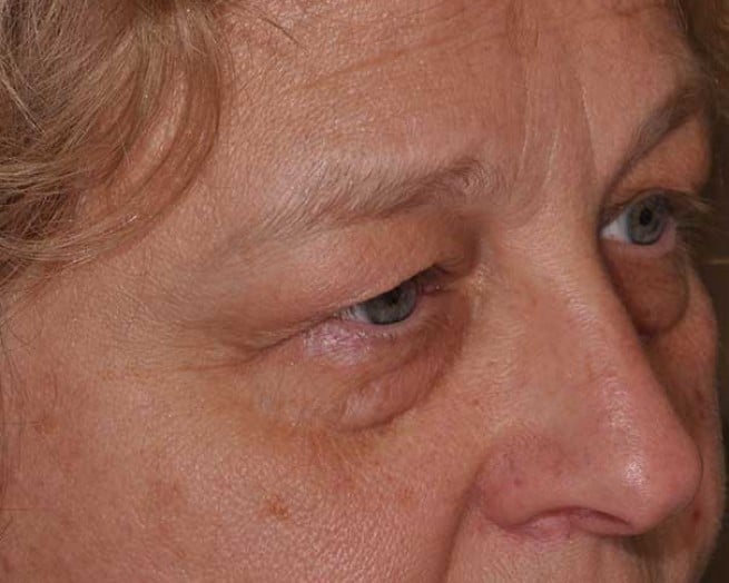 Blepharoplasty (Eyelid Surgery) in St. Louis &#038; St. Peters