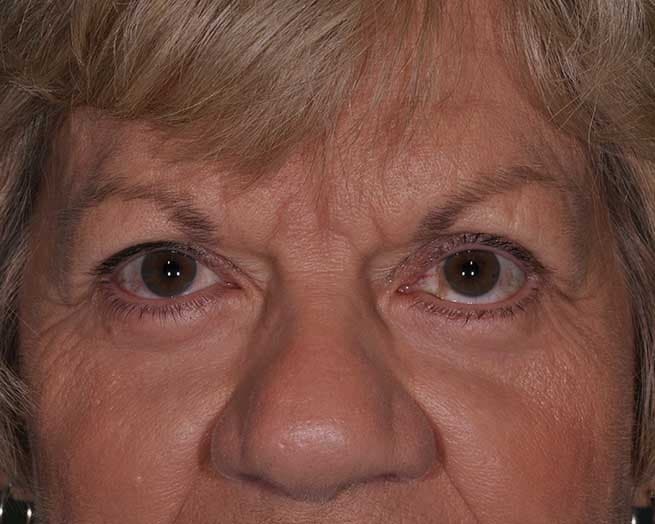 Lower Eyelid Blepharoplasty in St. Louis, MO