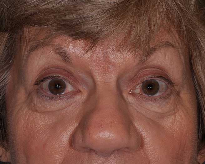 Lower Eyelid Blepharoplasty in St. Louis, MO