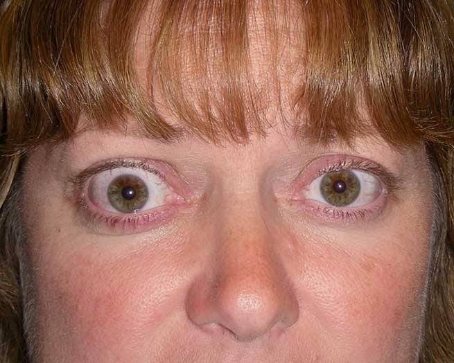 Thyroid Eye Disease in St. Louis, And St. Peters, MO