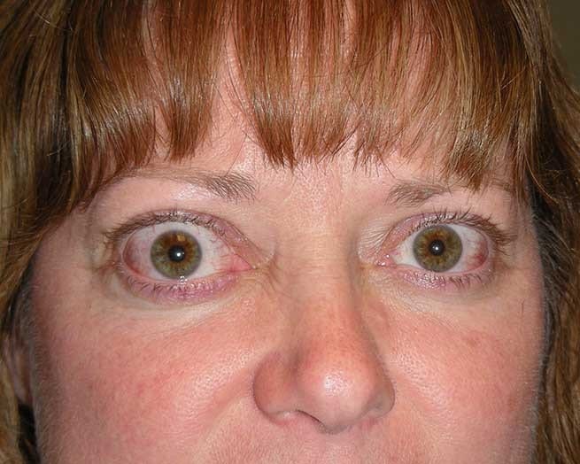 Thyroid Eye Disease in St. Louis, And St. Peters, MO